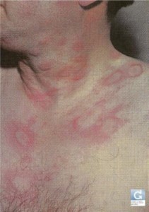 Urticaria (hives) « Globale Dermatologie